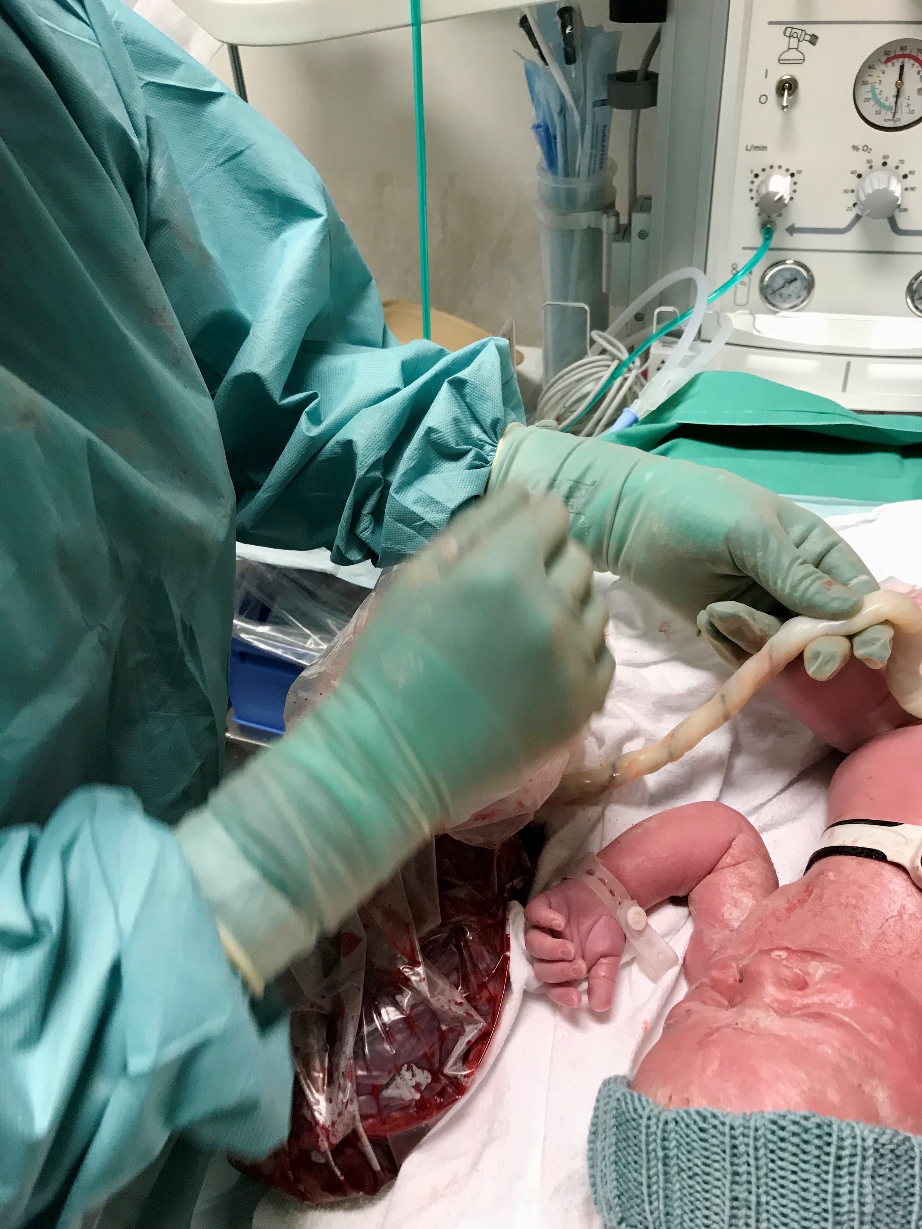 En person i grønne klær som klipper navnestrengen til en baby.