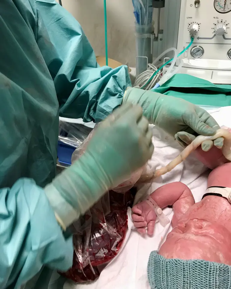 En person i grønne klær som klipper navnestrengen til en baby.